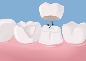 affordable dental crowns, Lawrenceville Hwy, Lilburn, GA