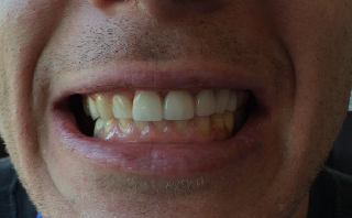 Post-operative image displaying restored and properly aligned teeth.