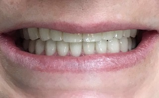 Post-operative image of restored and aligned teeth.