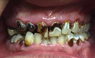 Pre-operative image of severe tooth decay and damage.