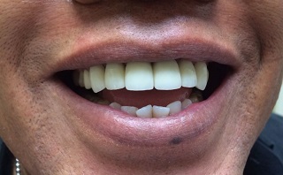 Post-operative close-up of dentition, displaying fully restored and aesthetically aligned dental implants.