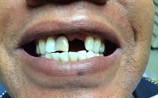 Close-up of a patient's teeth before a dental implant, showing gaps and misalignment.