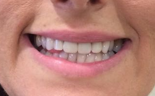 Post-treatment close-up displaying a restored, uniform smile after crown placement.