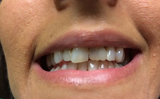 Pre-treatment close-up showing worn and uneven teeth before crown placement.