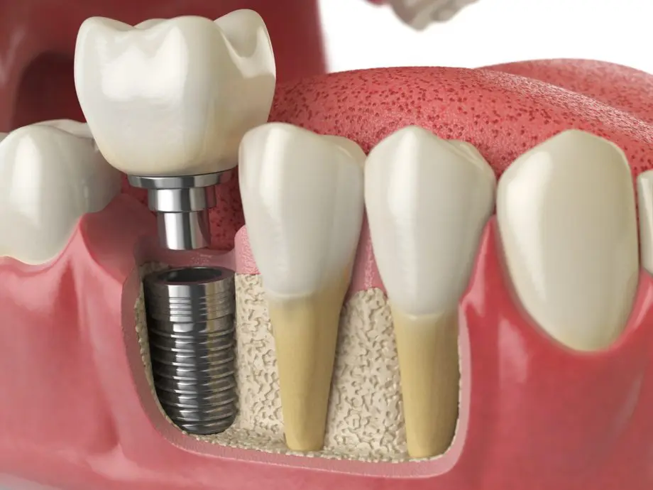 The Affordable Dental Implant Process: Step-by-Step Guide to Your New Smile