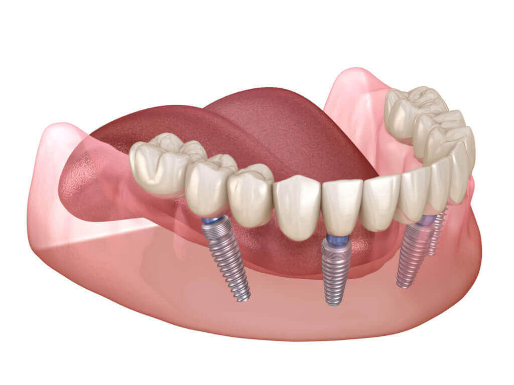 Financing Your Smile Makeover: Affordable Dental Implants for All