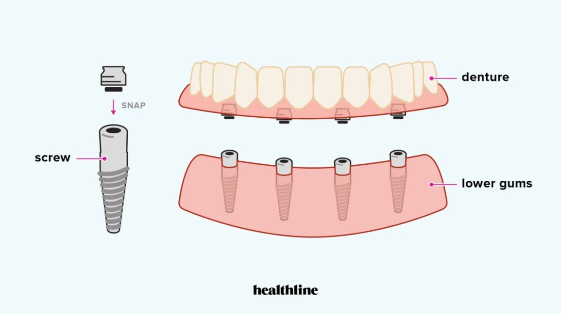 Breaking Down the Costs: Affordable Dentures Explained
