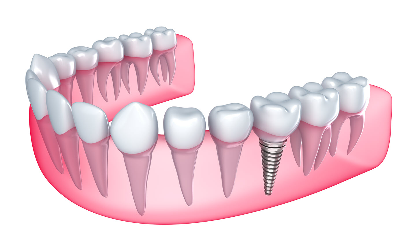 Affordable Dental Implants: Why You Shouldn't Settle for Missing Teeth