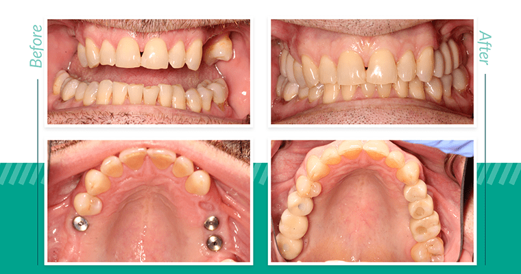 The Affordable Dental Implant Journey: From Consultation to Final Smile