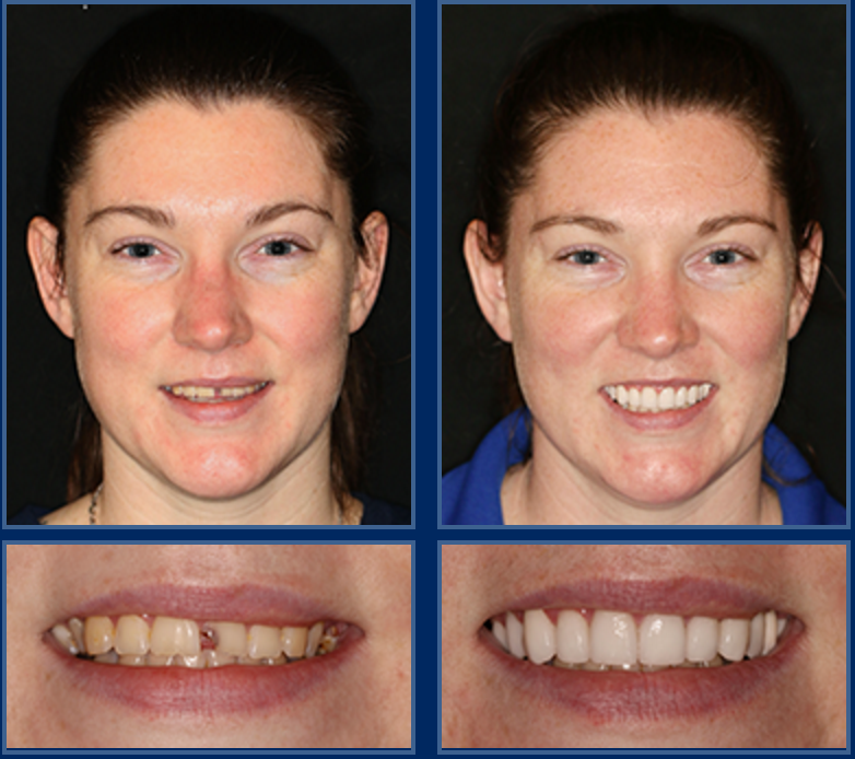 Achieving a Radiant Smile on a Budget: Affordable Dental Implants