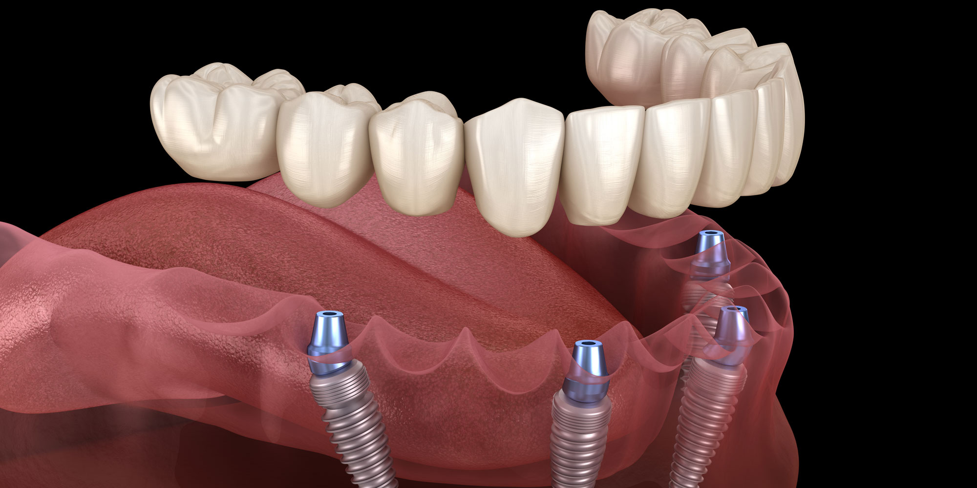 Affordable Dental Implants: Restoring Function and Aesthetics