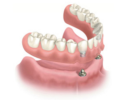 Fearing the Dentist? Discover Gentle and Affordable Dental Implants