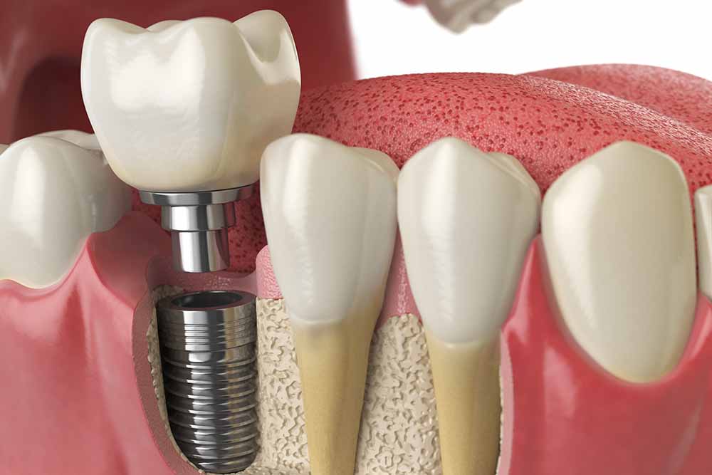 Affordable Dental Implants: Delivering Quality Without Compromise