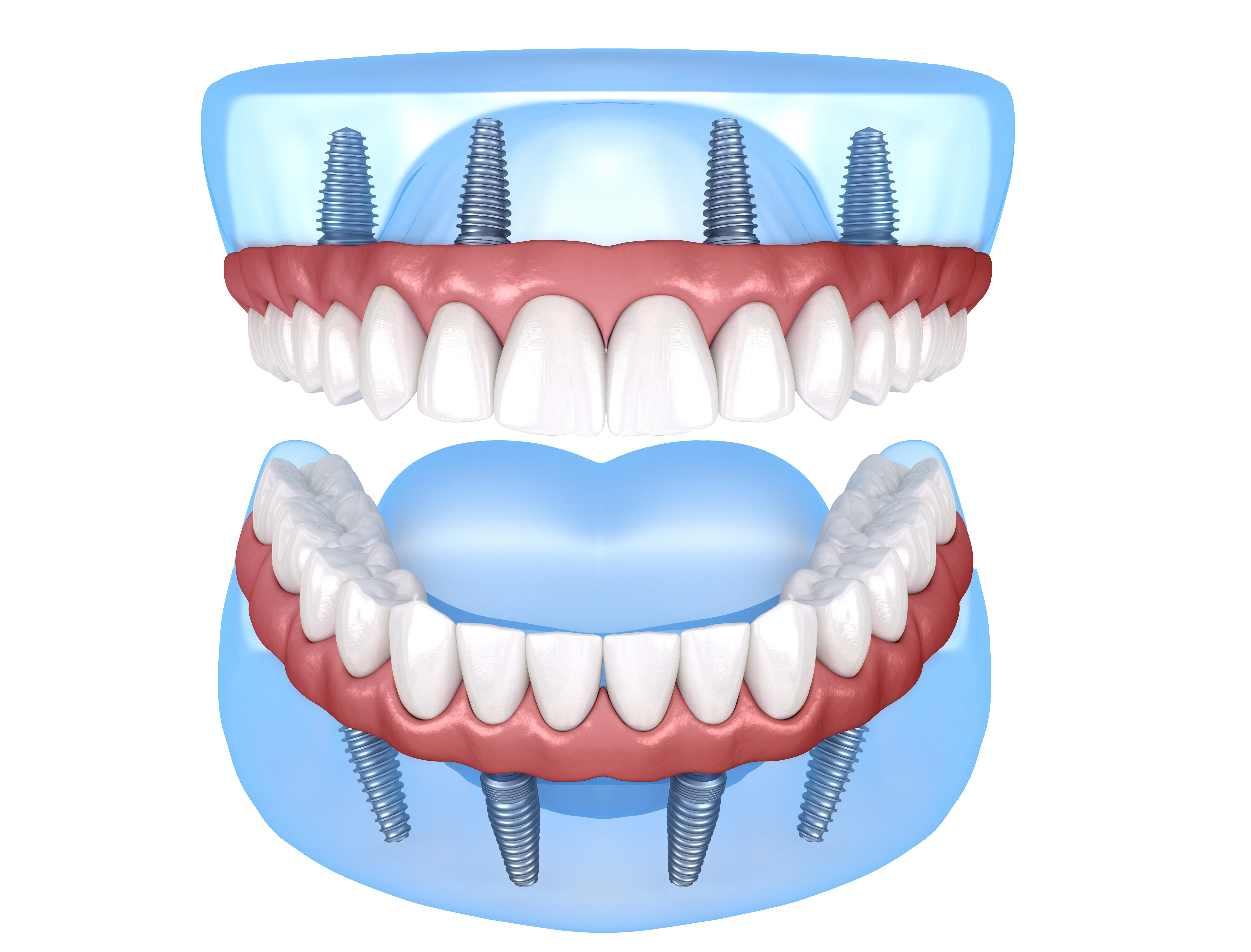 Affordable Dentures for All: Accessible Dental Solutions