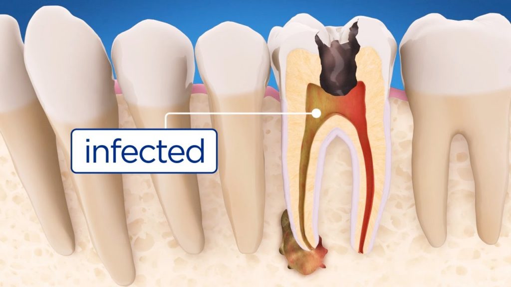 Affordable Root Canal Therapy: Saving Your Natural Teeth