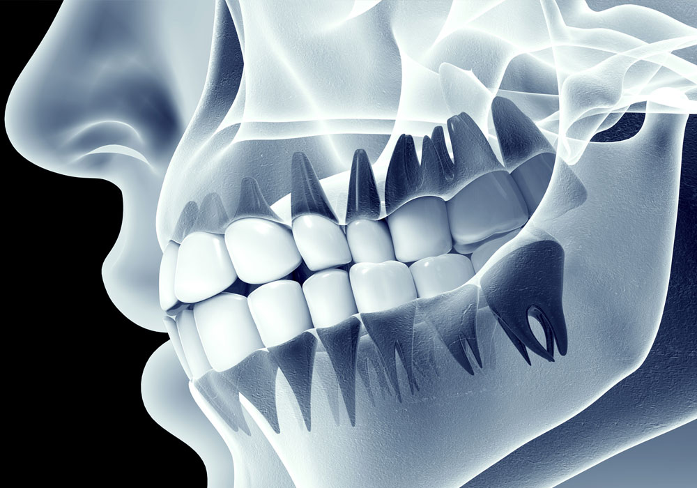 Understanding Dental X-Rays: Safety and Affordability