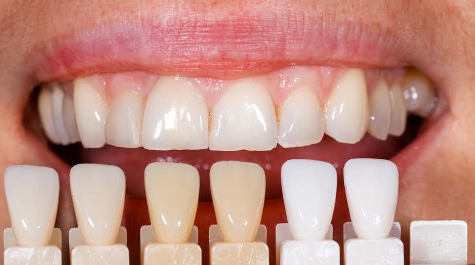 Affordable Veneers: Enhance Your Smile on a Budget