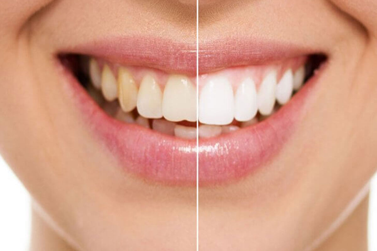Budget-Friendly Teeth Whitening Options: Brighten Your Smile Without Overspending