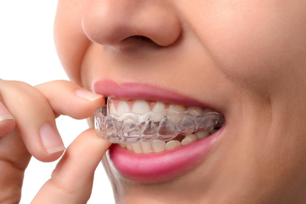 Affordable Invisalign: Straighten Your Teeth Comfortably and Cost-Effectively