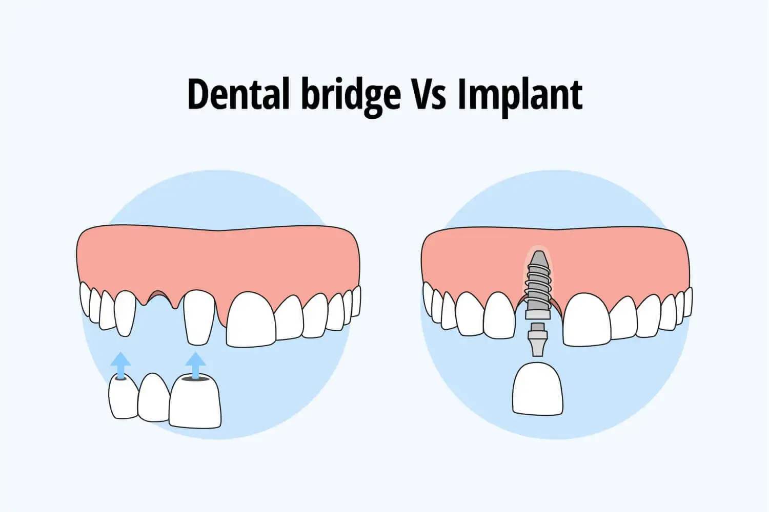 Affordable Solutions for Restoring Missing Teeth: Bridges vs. Implants