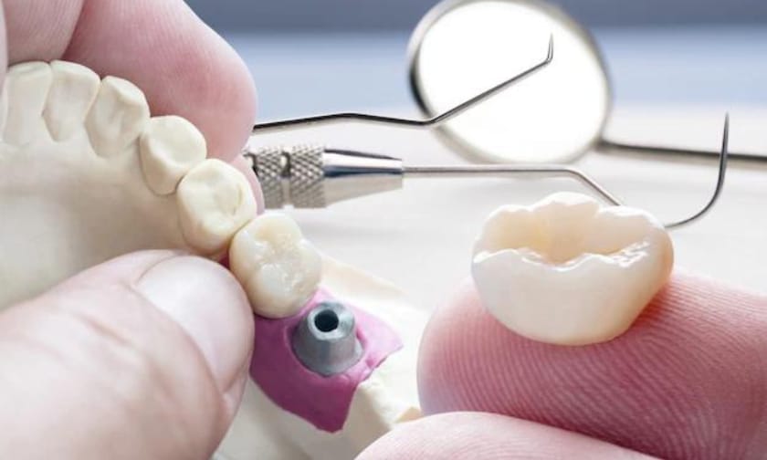 Affordable Dental Crowns: Regain Your Confident Smile Without Draining Your Wallet