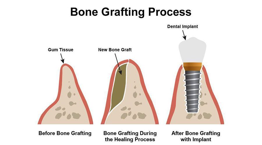 Affordable Bone Grafting: Building a Strong Foundation for Implants