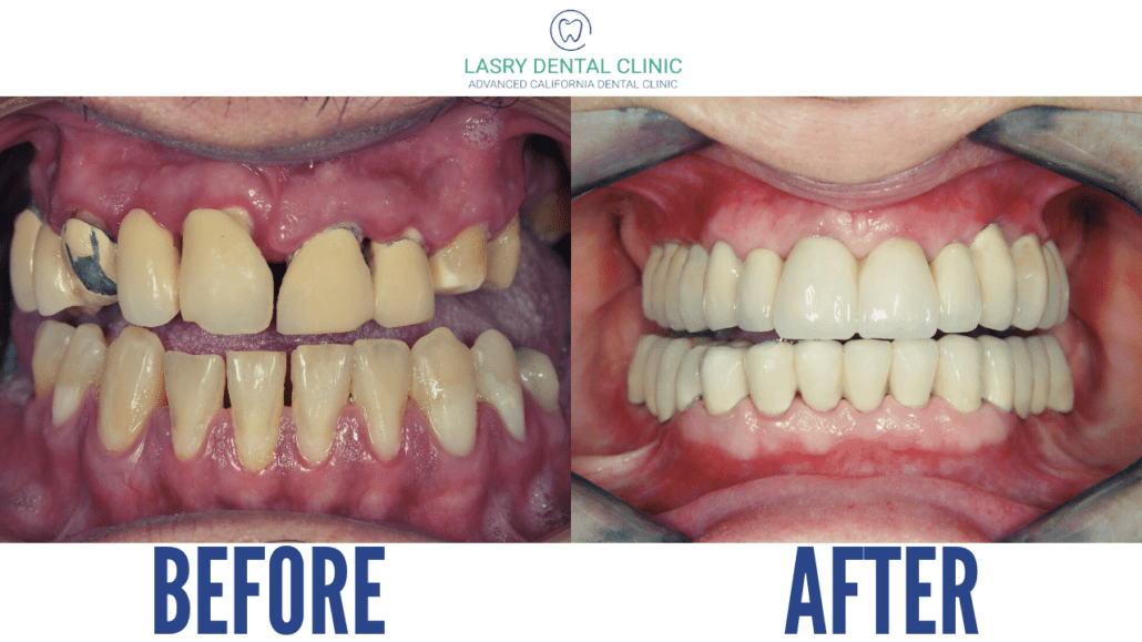 Affordable Full Mouth Reconstruction: Restoring Your Smile at a Reasonable Cost