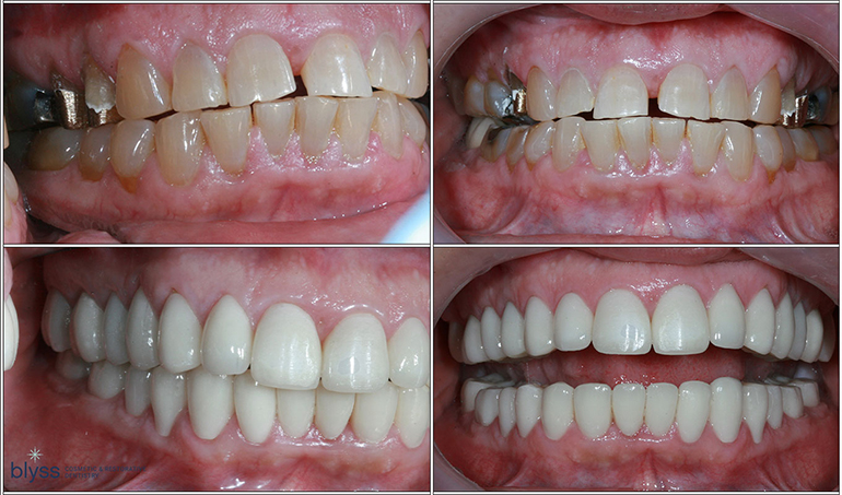 Affordable Full-Mouth Reconstruction: Restoring Oral Function and Aesthetics