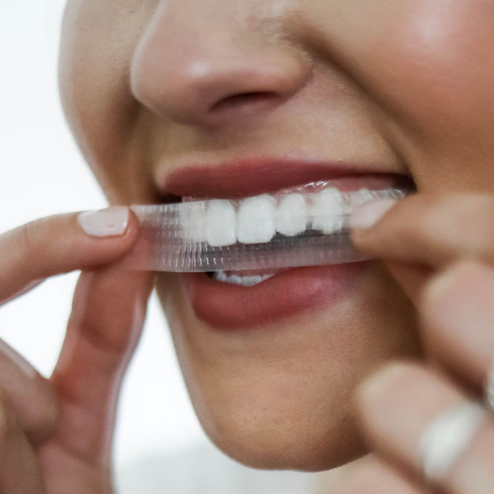 Affordable Teeth Whitening: Brightening Your Smile on a Budget