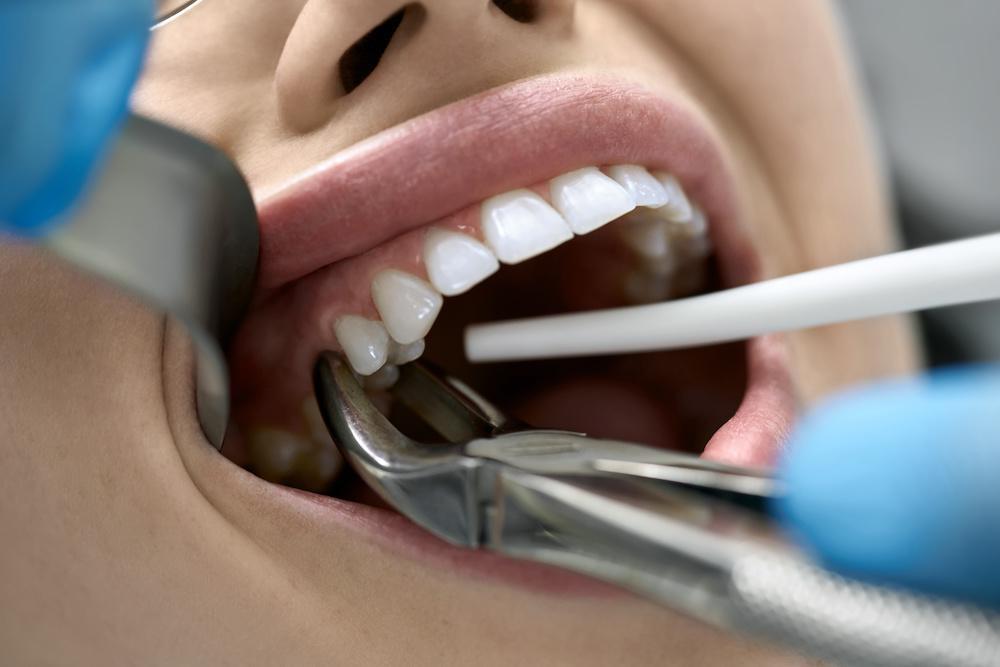 Say Goodbye to Tooth Pain: Affordable Extractions with Our Expert Dentist