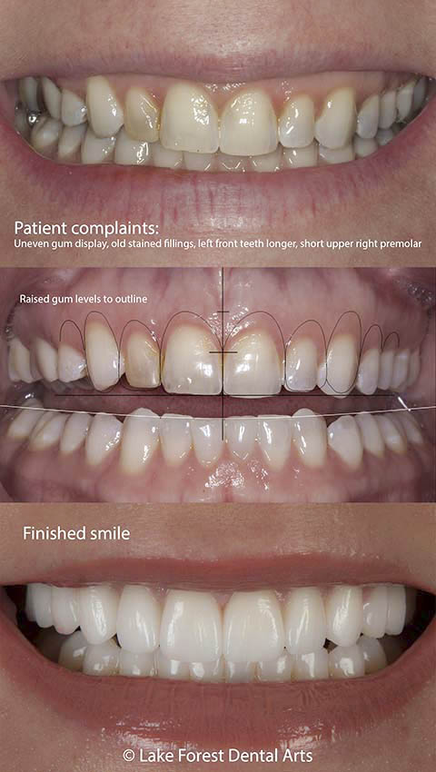 Affordable Gum Contouring: Reshape Your Smile and Transform Your Look