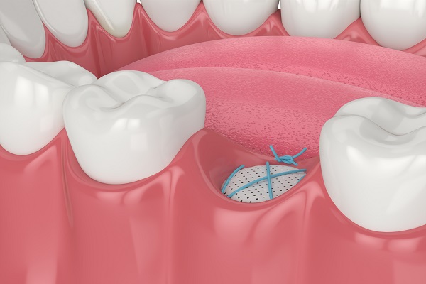 Affordable Tooth Removal: Preserving Oral Health with Care