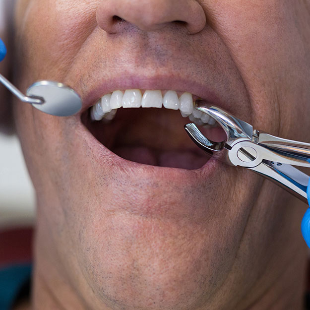 Affordable Dental Extractions: A Wise Choice for Your Oral Well-being