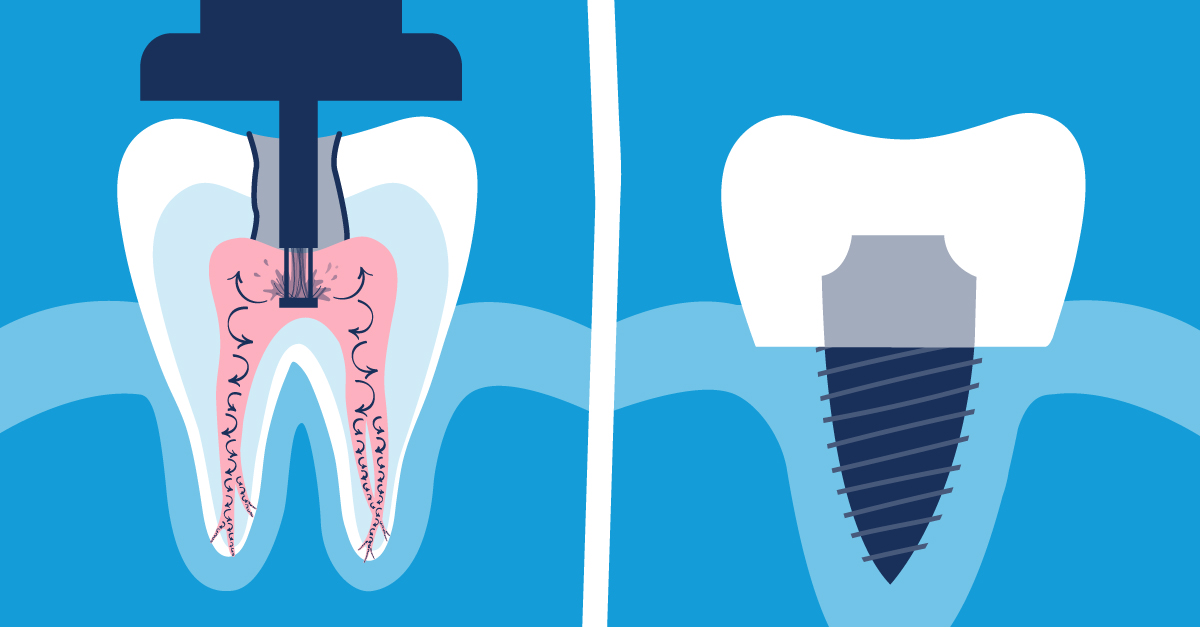 Exploring Affordable Root Canal Alternatives for Dental Health