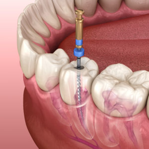 Affordable Root Canal Therapy: Preserving Your Natural Teeth