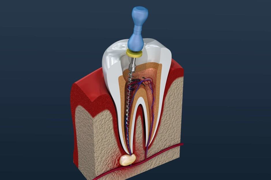 Affordable Root Canal Specialists: Putting Your Mind at Ease