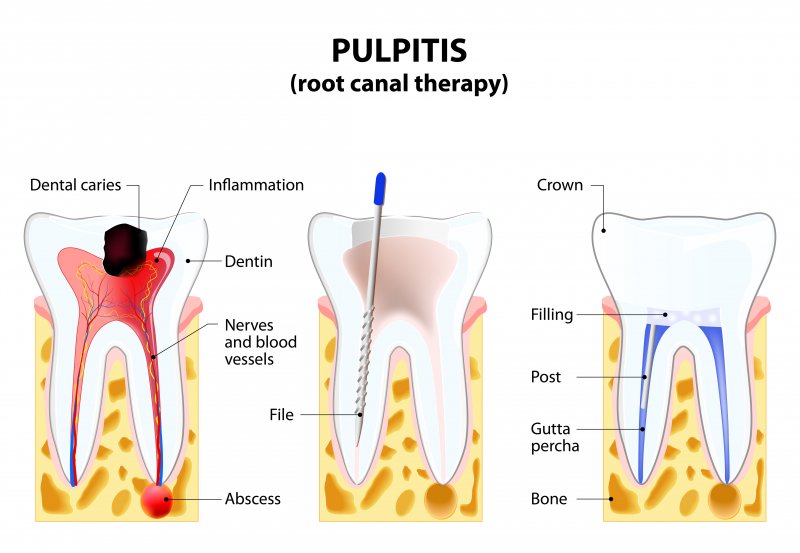 Root Canal Myths Debunked: Truths from an Affordable Dentist