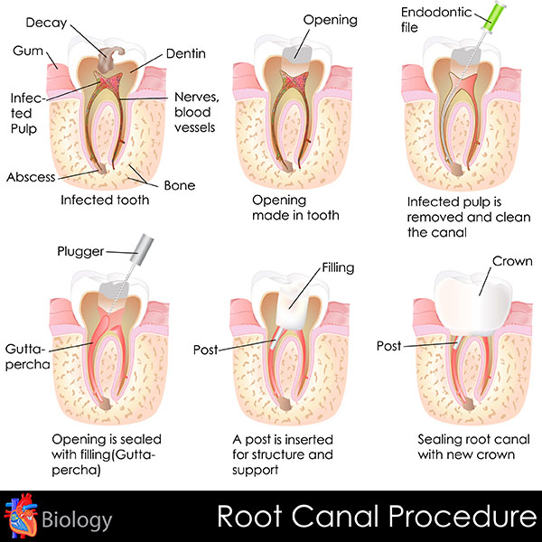 Root Canal Aftercare: Tips from an Affordable Dental Expert