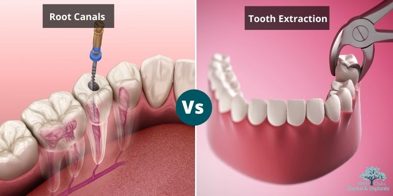 Affordable Dental Solutions: Root Canals vs. Tooth Extraction