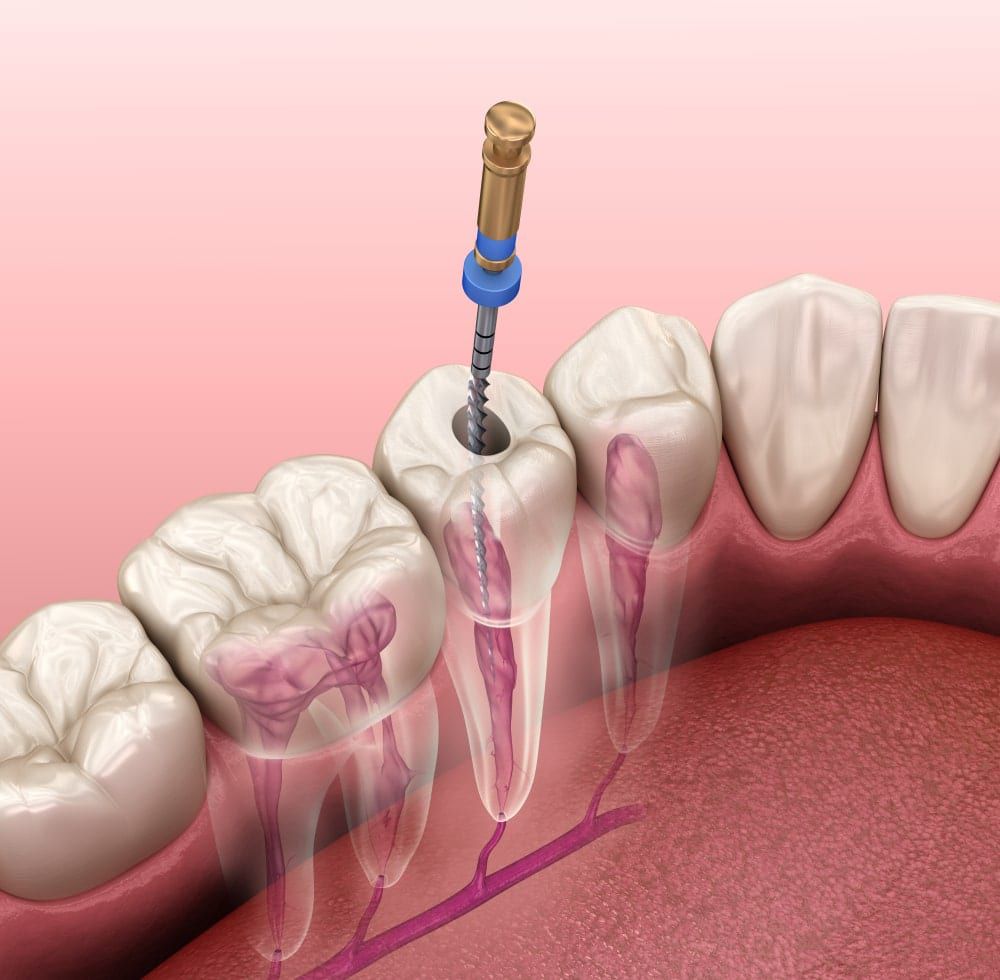 Affordable Root Canal Therapy: Restoring Dental Health, One Tooth at a Time