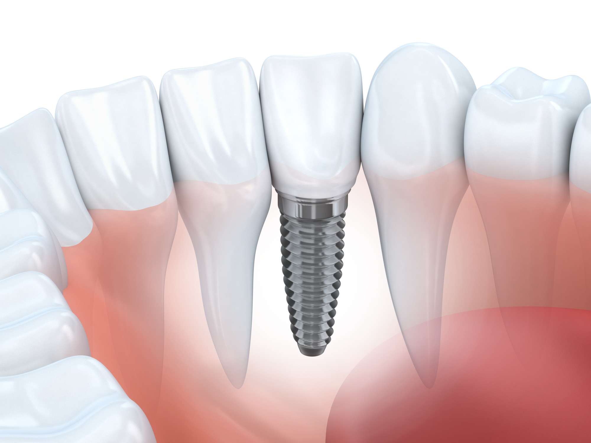 Painless Root Canals at an Affordable Dental Clinic: Discovering the Difference
