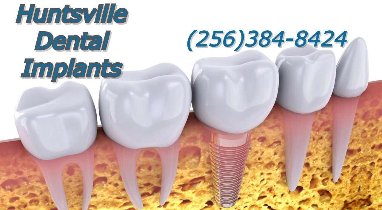 How Dental Implants Can Improve Your Quality of Life and Save You Money