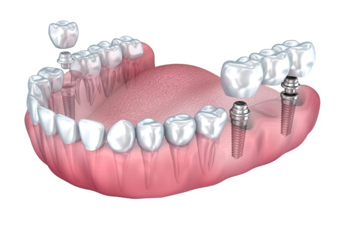 Dental Implants: Affordable, Long-lasting Solutions for Missing Teeth