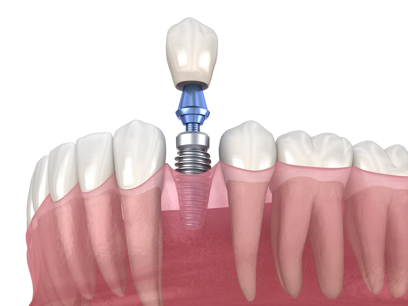Budget-Friendly Dental Implants: Why They're Worth the Investment