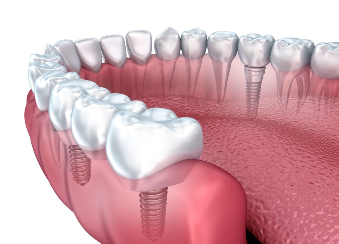 The Key to Affordable Dental Implants: Understanding Your Options
