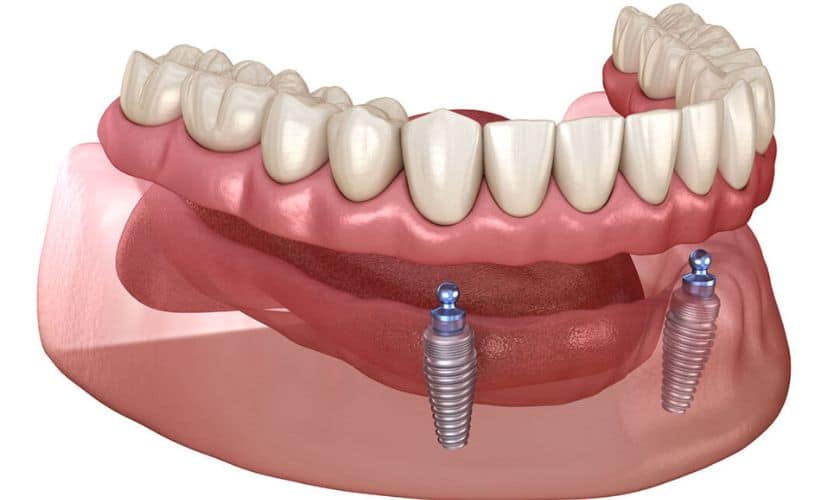 Affordable Dental Implants: Breaking Barriers to Accessible Dental Care