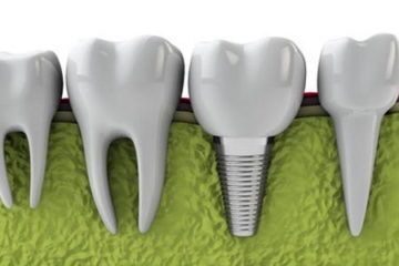 Unlocking Affordable Dental Implants: Financing and Payment Plans