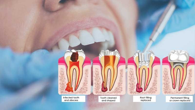 How to Save Money on Root Canal Treatment in India Without Compromising  Quality | by Signature Smile | May, 2023 | Medium