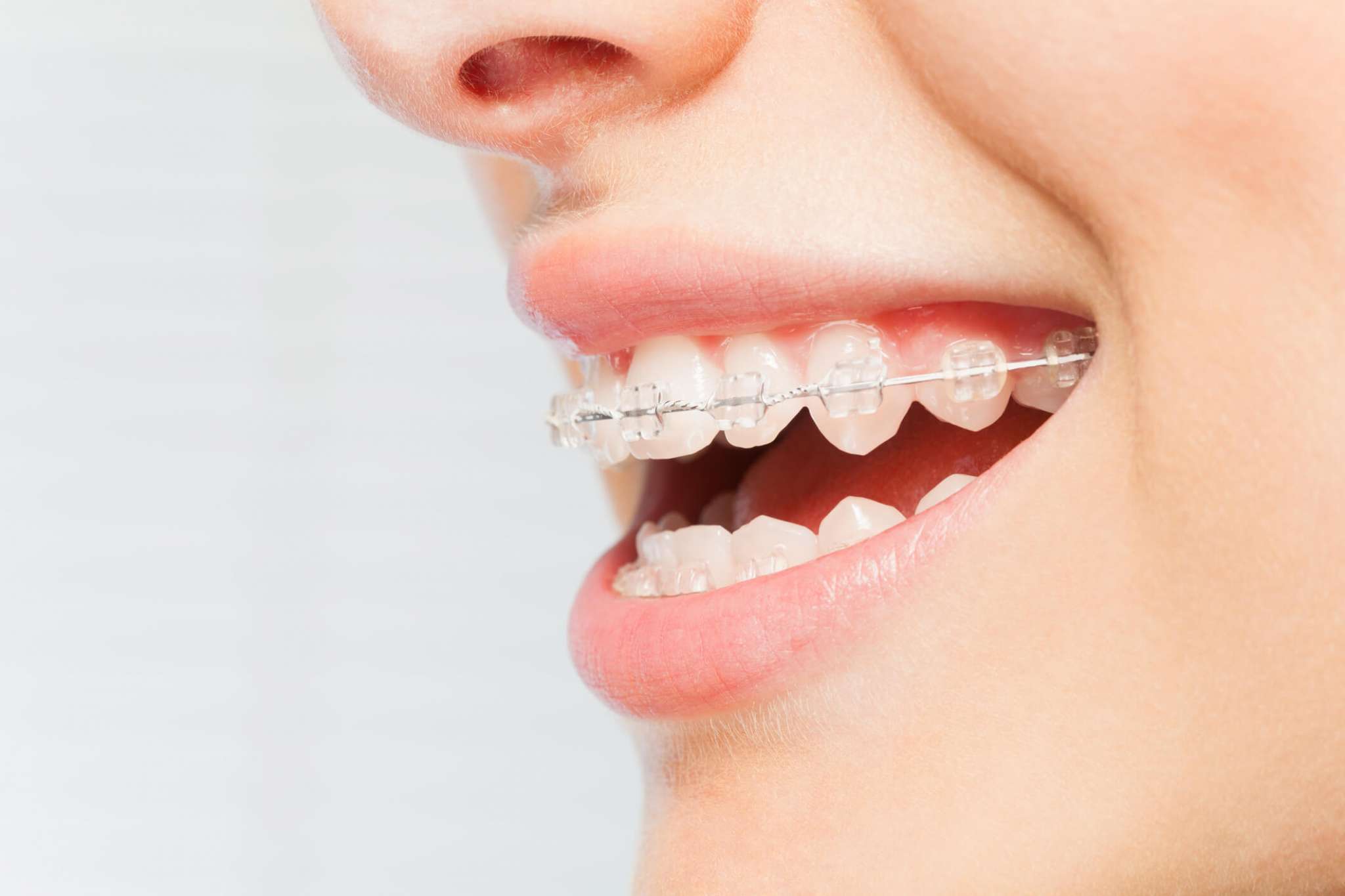 Inexpensive Braces: Straighten Your Teeth Without Costly Orthodontic Bills