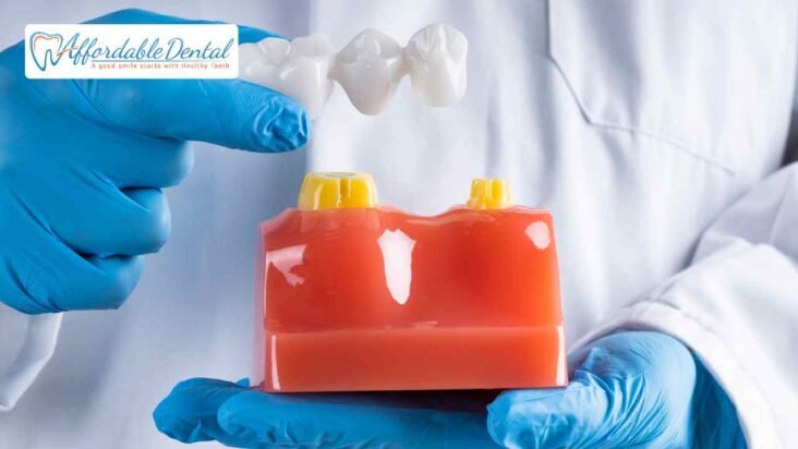 affordable bridges for teeth